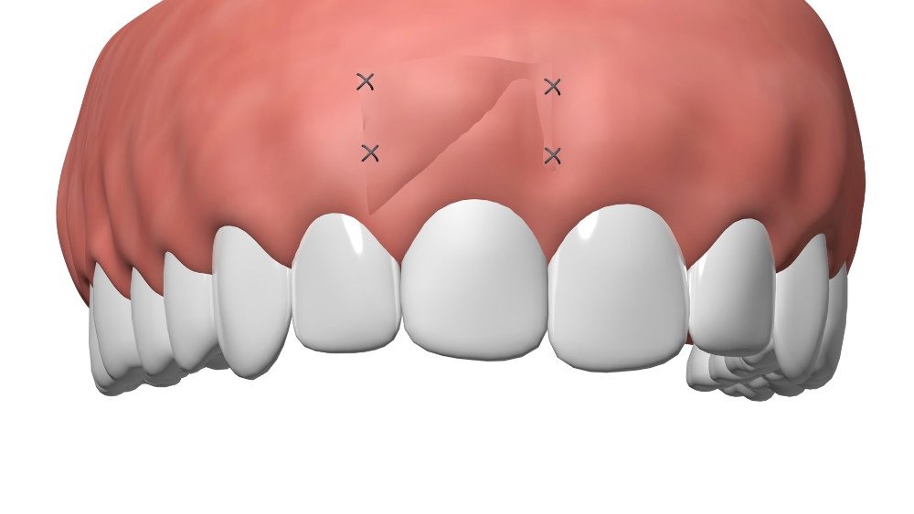 Cabinet dentaire Nimes Implant dentaire